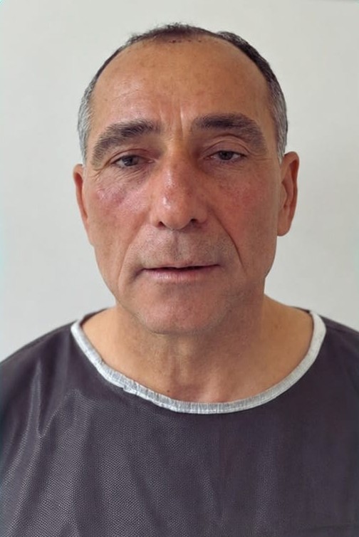 Saç ekimi öncesi — Hasta 2 — Mirva Saç Ekim